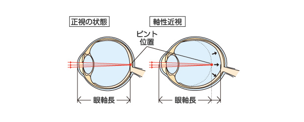 近視の説明